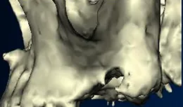 ソケットリフトとサイナスリフトの違い2