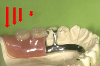 部分入れ歯：3DRと部分床義歯の噛む力の負担の違い