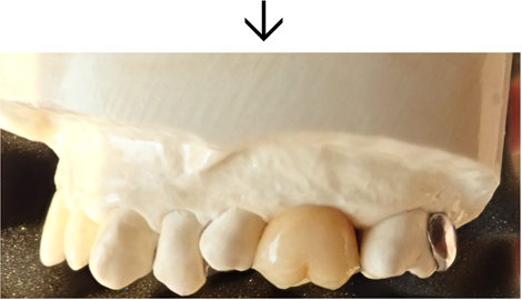 3DR義歯の特徴